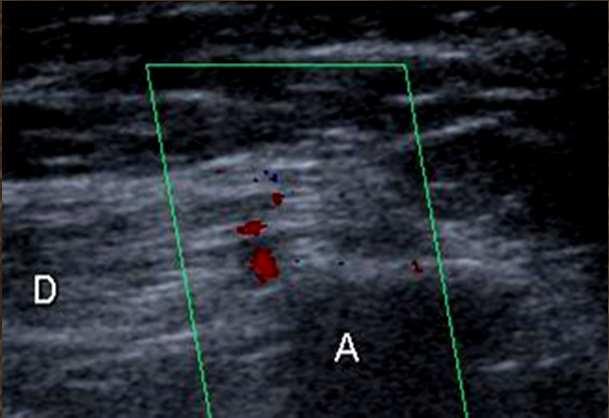 synovitis