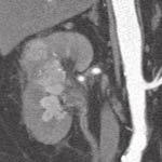 Nádor infiltroval renální sinus, neprorůstal však dle histologie ani do pánvičky ani do žil, jak se zdálo z CT obrazu, provedena translumbální nefrektomie.