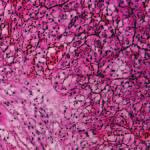 Při infiltrativním šíření konvenčního renálního karcinomu do pánvičky se v diferenciální diagnostice musí zvážit přítomnost uroteliálního karcinomu, neboť tento se vzácně vyskytuje i jako čistě
