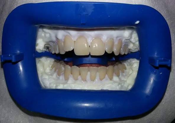 Nejčastěji se na zuby aplikuje bělící gel ve třech cyklech o 20 minutách, popřípadě ve čtyřech 15-ti minutových cyklech.