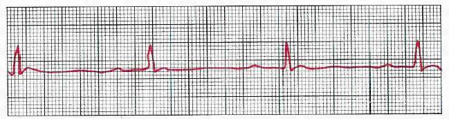 Sinusová bradykardie SINUS BRADYCARDIA Impuses originate at S-A