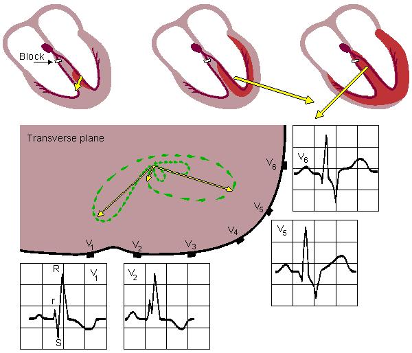 Blokáda pravého Tawarova raménka RIGHT BUNDLE-BRANCH BLOCK QRS