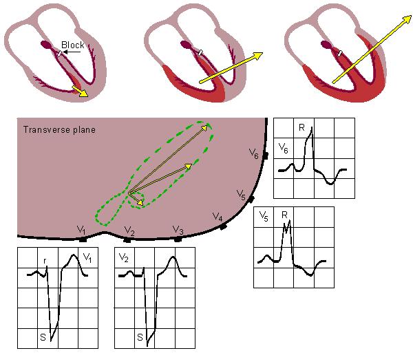 Blokáda levého Tawarova raménka LEFT BUNDLE-BRANCH BLOCK QRS duration
