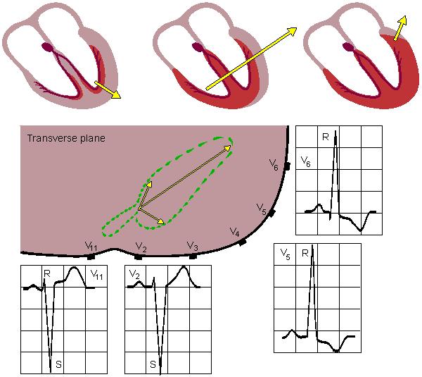 Hypertrofie levé komory LEFT VENTRICULAR HYPERTROPHY Large