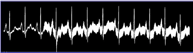 Rušení signálu EKG ÚZKOPÁSMOVÉ RUŠENÍ kolísání (drift) základní izoelektrické linie pomalé elektrochemické děje