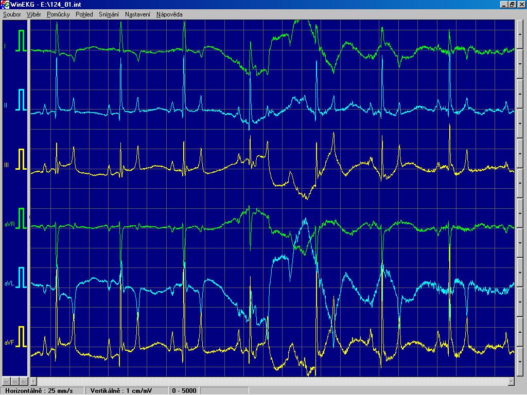 Rušení signálu EKG ŠIROKOPÁSMOVÉ RUŠENÍ myopotenciály
