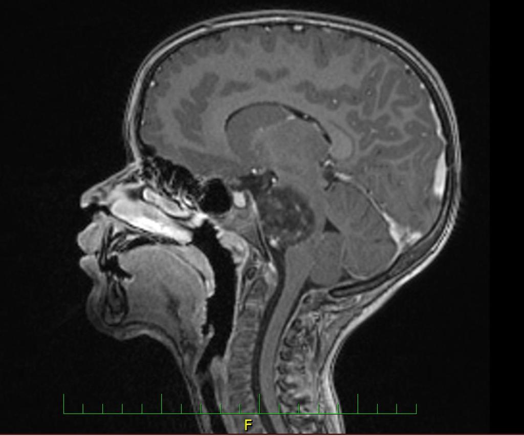 Diffuse midline glioma, H3 K27M-mutant vždy grade