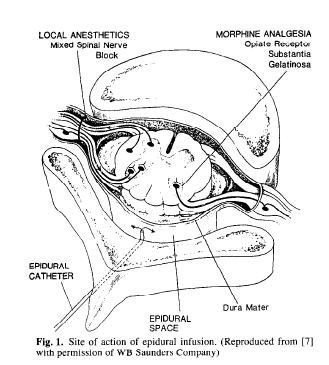 Epiduralní