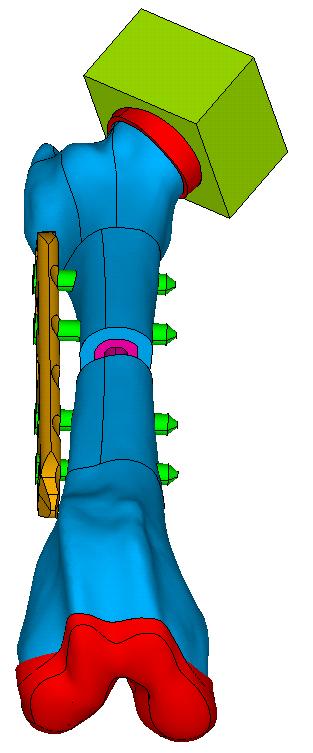 V prezentovaný způsob zatížení sloužil pro kalibraci a úpravu matematického modelu, který bude dále použit při analýzách namáhání systému fixace segmentálního defektu femuru 4,5 mm LCP při postavení