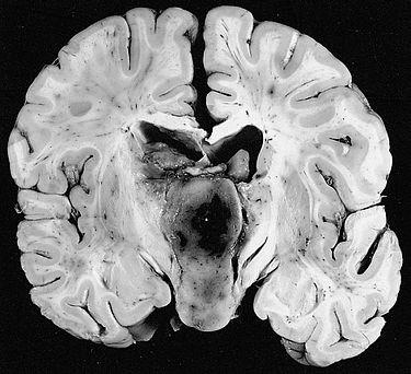 Nádorová onemocnění Nádory maligní NEUROEKTODERMOVÉ Dfúzní