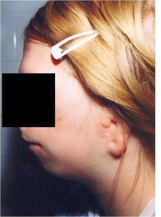 Microotia Syndrom Treacher- Collins