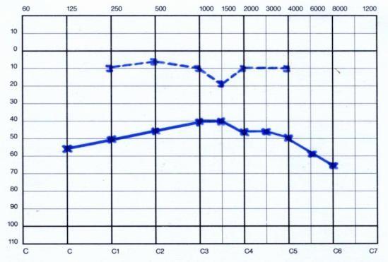 Klasická sluchová zkouška + audiogram P L 4 V 10 O,5 Vs 10 W + R + zkr.