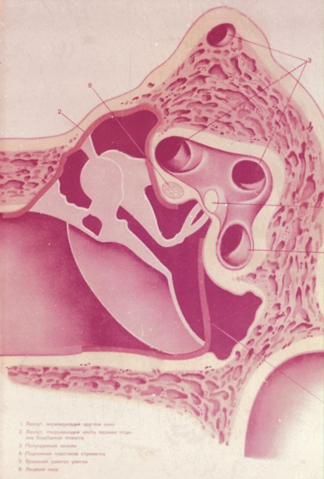 Tympanoplastika typ IV.