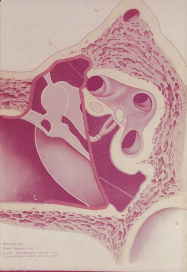 Tympanoplastika typ V.