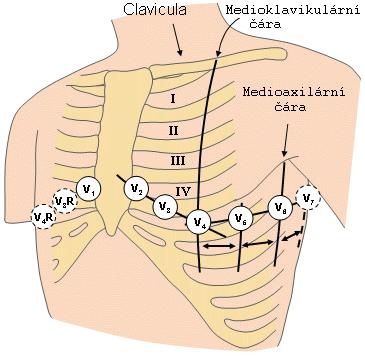 Obrázek 6: Rozmístění hrudních unipolárních elektrod.