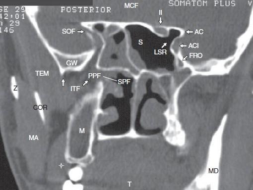 Anatomické struktury okolí klínové dutiny m.