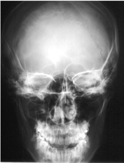 5 sinus frontalis, 6 septum sinuum frontalium, 7 crista galli, 8 ala minor ossis sphenoidalis, 9 fissura orbitalis superior, 10 ala major ossis sphenoidalis (ortorentgenográdní projekce),11 pars