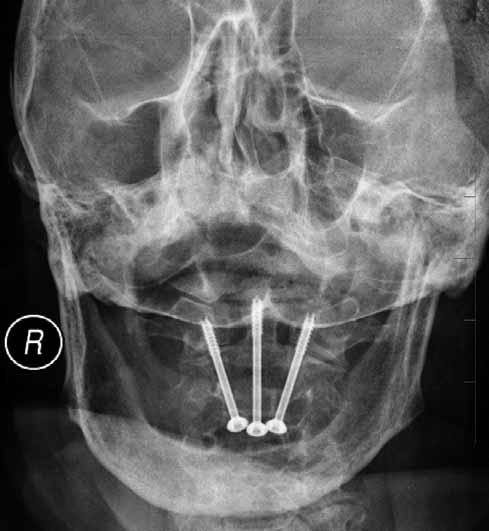 Pacientek nad 85 let bylo šest. Všechny pacientky byly v době přijetí bez Obr. 1. CT boční projekce zlomeniny zubu čepovce s dorzální dislokací.