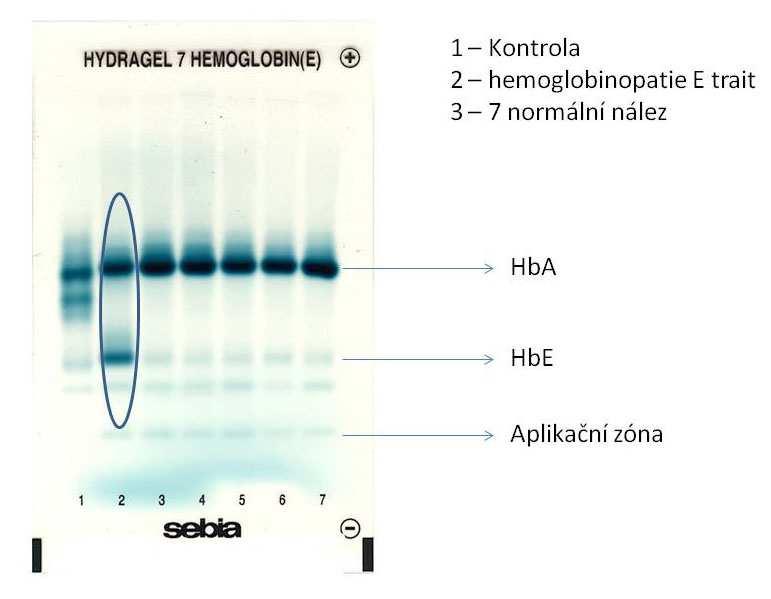 Tabulka 12 Laboratorní nález pacientky v čase Laboratorní vyšetření 1997 27. 7.