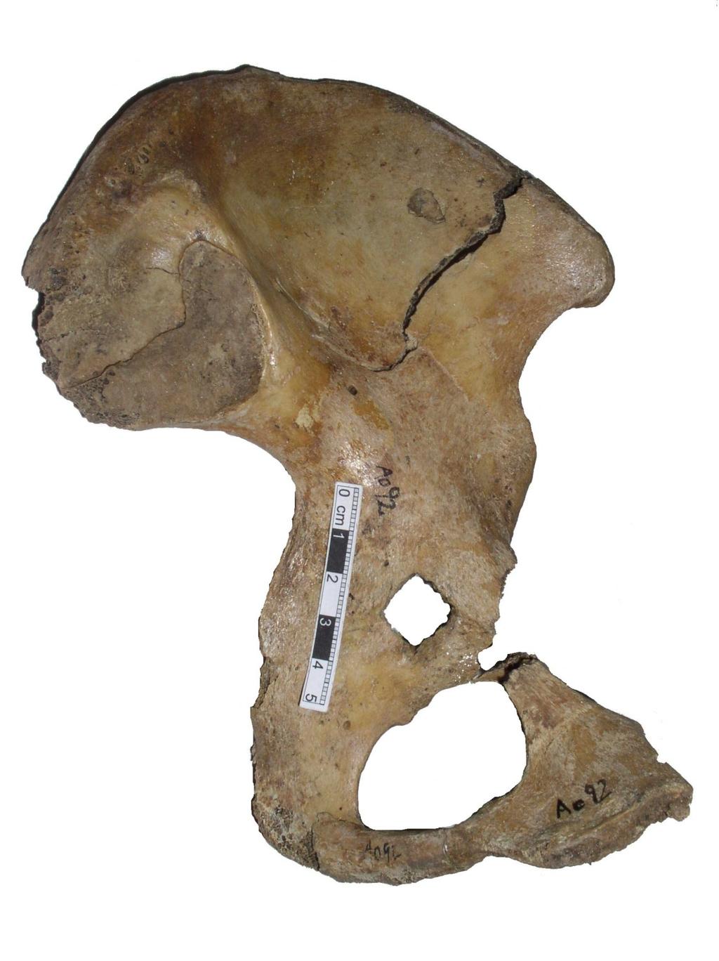 Poporodní změny Jedná se o jamky po hematomech v oblasti incisura ischiadica major nebo v oblasti facies