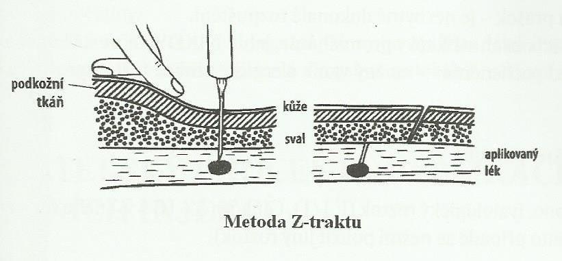 Příloha I Metoda Z-traktu Zdroj: POKORNÁ, Andrea a kol. 2014.