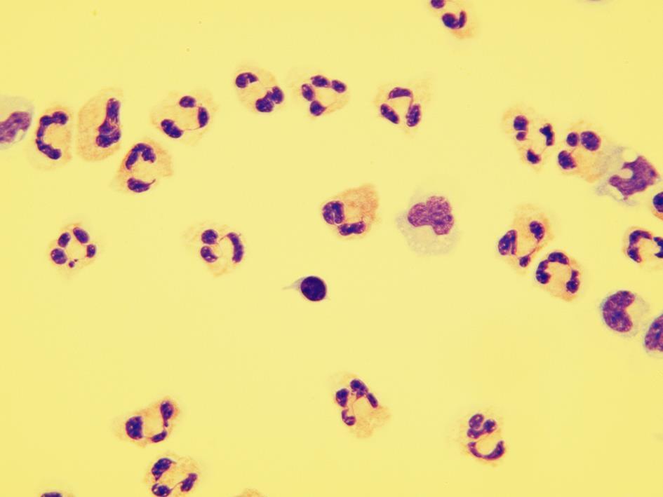 Typy cytologických likvorových nálezů: Podle početně převažující řady dělíme pleocytózu nebo patologickou oligocytózu na granulocytární, lymfocytární, monocytární nebo tumorózní.