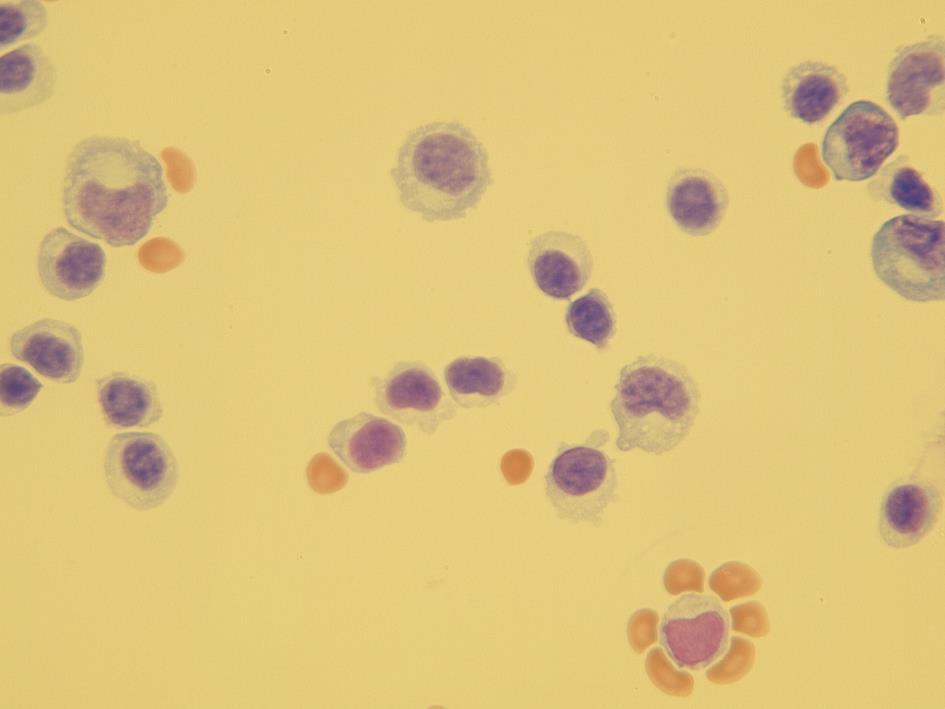 Obr. 22 Lymfocytární pleocytóza (zvětšení 400x) Lymfocytární oligocytóza se často nachází v počáteční fázi roztroušené sklerózy.