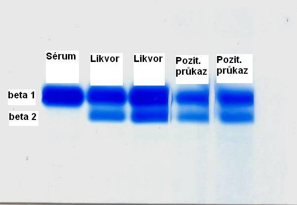 Průkaz likvorey Někdy je důležité určit, zda u pacienta po úrazu hlavy je sekret vytékající z nosu jen zánětlivý exsudát z nosní sliznice nebo mozkomíšní mok.