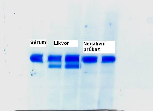 Detekce likvoru je možná stanovením parametru specifického pro likvor. K dispozici je stanovení beta trace proteinu enzymu, který je syntetizován v buňkách chorioideálního plexu.