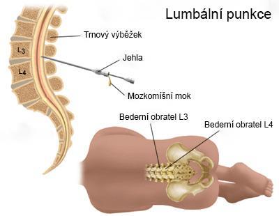 Obr. 6 Lumbální punkce zdroj: http://www.daviddarling.info/encyclopedia/l/lumbar_puncture.html Komplikace lumbální punkce Suchá punkce může být způsobena nesprávnou polohou jehly např.