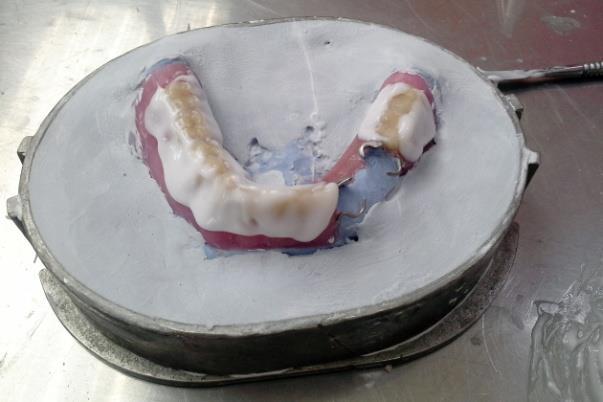 Ordinační fáze Zkouška konstrukce s postavenými zuby v ústech pacienta. Lékař může s umělými zuby hnout, když vidí v ústech pacienta artikulační překážku.