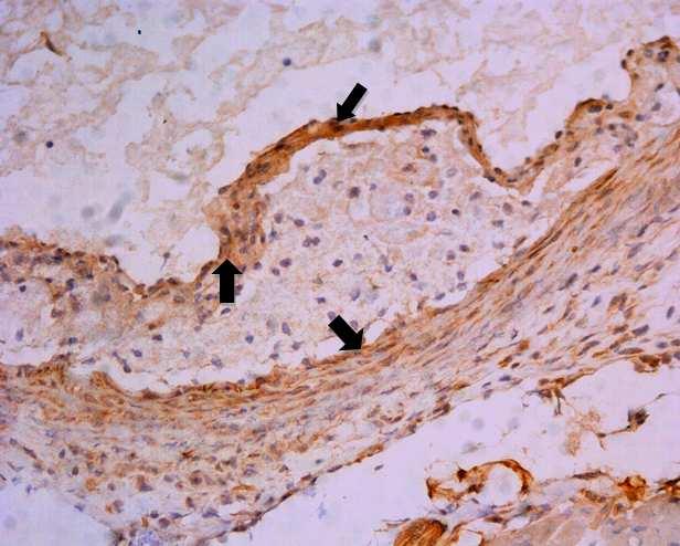 Obrázek 15: Reprezentativní obrázek barvení ALK-5 u cholesterolové skupiny zvířat. Silná exprese je viditelná v medii cév (šipky).