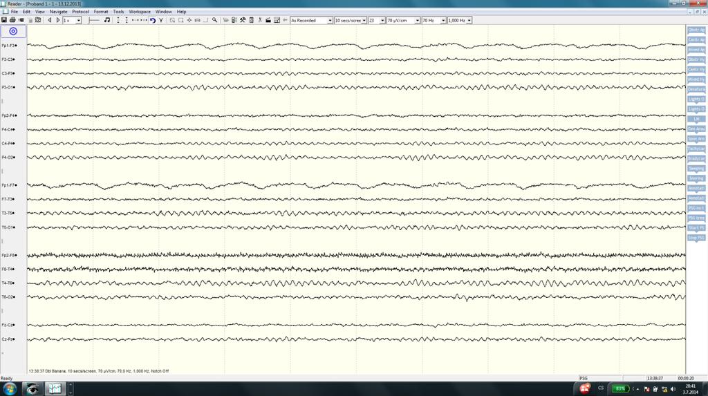 Obr. 3.2 Nativní EEG před cvičením čchi-kungu proband 1 Na grafu 3.1 vidíme časový výskyt alfa aktivity při cvičení čchi kungu.