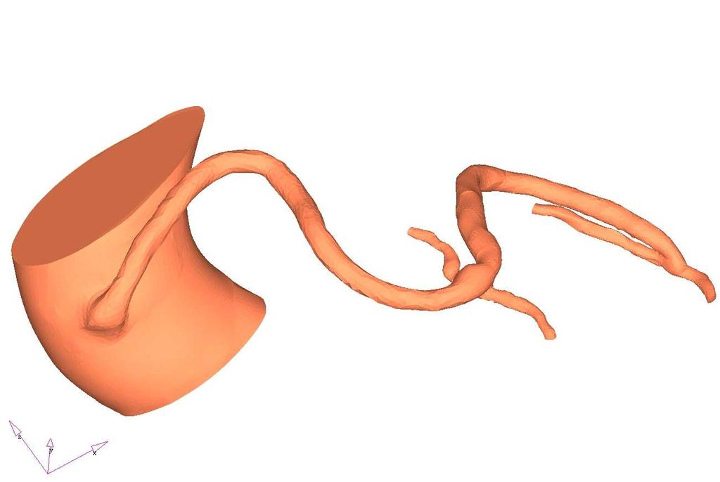 3D model reálného sekvenčního aorto-koronárního bypass získaného ze snímků