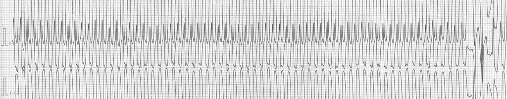 EKG Bezpulzová