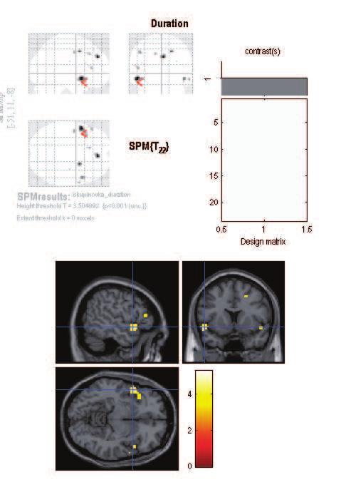 Tabulka 2 - Výsledné regiony a jejich parametry. Region Souřadnice [x, y, z] Počet voxelů T max Putamen [-21 2 15] 10 4,59 STG posterior + STS posterior [-42-55 22] 17 4,53 7.2.2 Blokový design s adaptací na variabilitu reakčního času Na obrázku 22 vidíme, jako na předešlých obrázcích, aktivní voxely zobrazené na tzv.