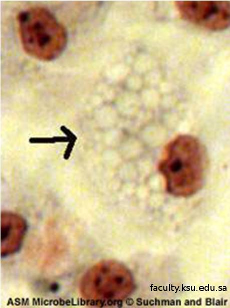 Cytopatický efekt (7) foamy degeneration (vaculalization) produkce velkých a početných vakuol v