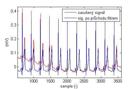 Obr. č. 22: Průběh EKG signálu s aditivní složkou rušení v rozsahu od 0 Hz do 0,05 Hz a průběh signálu po průchodu Lynnovým filtrem typu horní propust Obr. č. 23: Detail průběhu referenčního EKG signálu a detail průběhu signálu po průchodu Lynnovým filtrem typu horní propust Míru zkreslení užitečného signálu zaznamenává obr.