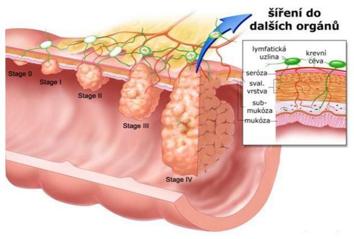 Tab. 8.: Rozdělení do určitých stádií [2] Stádium 0 Tis N0 M0 Stádium I T1,2 N0 M0 Stádium II T3,4 N0 M0 Stádium III TX 4 N1,2 M0 Stádium IV TX - 4 NX 2 M1 Obr. 9.