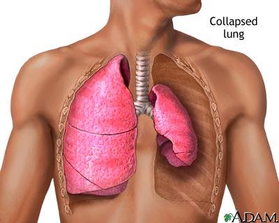 Pneumothorax Zavřený Otevřený Tenzní Příčiny: Spontánní ruptura plíce (emfyzém, nádor,zánět, vrozená vada) Tupé zhmoždění