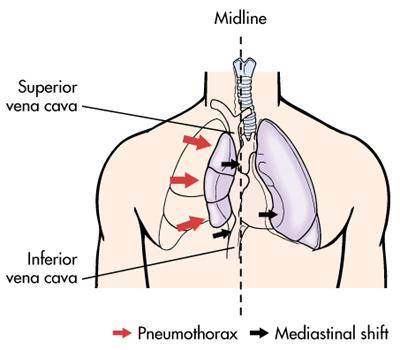 Tenzní (záklopkový) pneumothorax Život ohrožující stav!