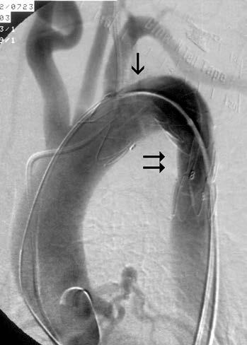 Obr. 3a. Digitální subtrakční angiografie (DSA) nemocné s akutní aortální disekcí typu B, komplikované krvácením do pleurální dutiny.