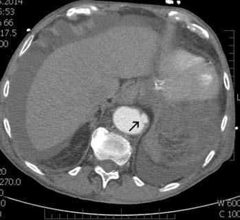 Obr. 4. Příklad ULP v oblasti distální hrudní aorty (CTA). Šipka označuje průnik kontrastu do trombozovaného intramurálního hematomu Obr. 5a, b.