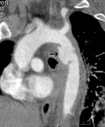 subclavia (dvě projekce) A B Mezi příčinami smrti u traumat je poranění aorty svou četností na druhém místě, hned za intrakraniálním krvácením.