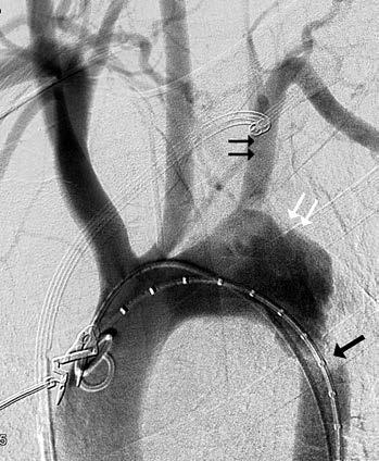 V roce 2011 vydala the Society for Vascular Surgery (SVS) guidelines (12) týkající se endovaskulární léčby aortálního traumatického poškození a součástí byla i morfologická klasifikace.