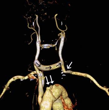 cm a perzistencí nepravého lumen. CT angiografie (2D rekonstrukce) prokazuje počátek nepravého lumen (bílá šipka) v oblasti odstupu levé a. carotis communis.