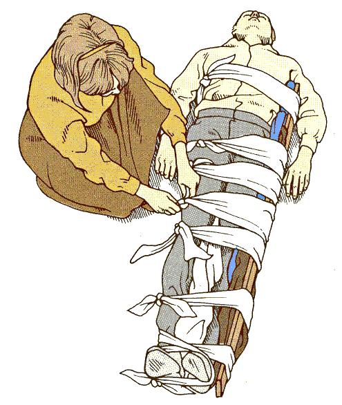 znehybnění kyčle, stehna a kolena Provádíme pomocí dlah nebo pevných rovných předmětů jednu dlahu přiložíme ze strany k hrudníku přes kyčel na