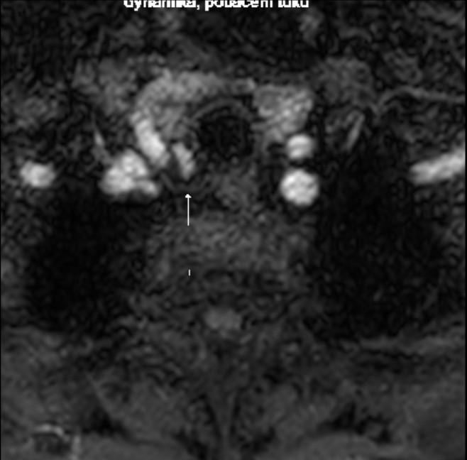Obr. 6: postkontrastní T1 W MR dynamická sekvence s potlačením tuku je optimální pro MR