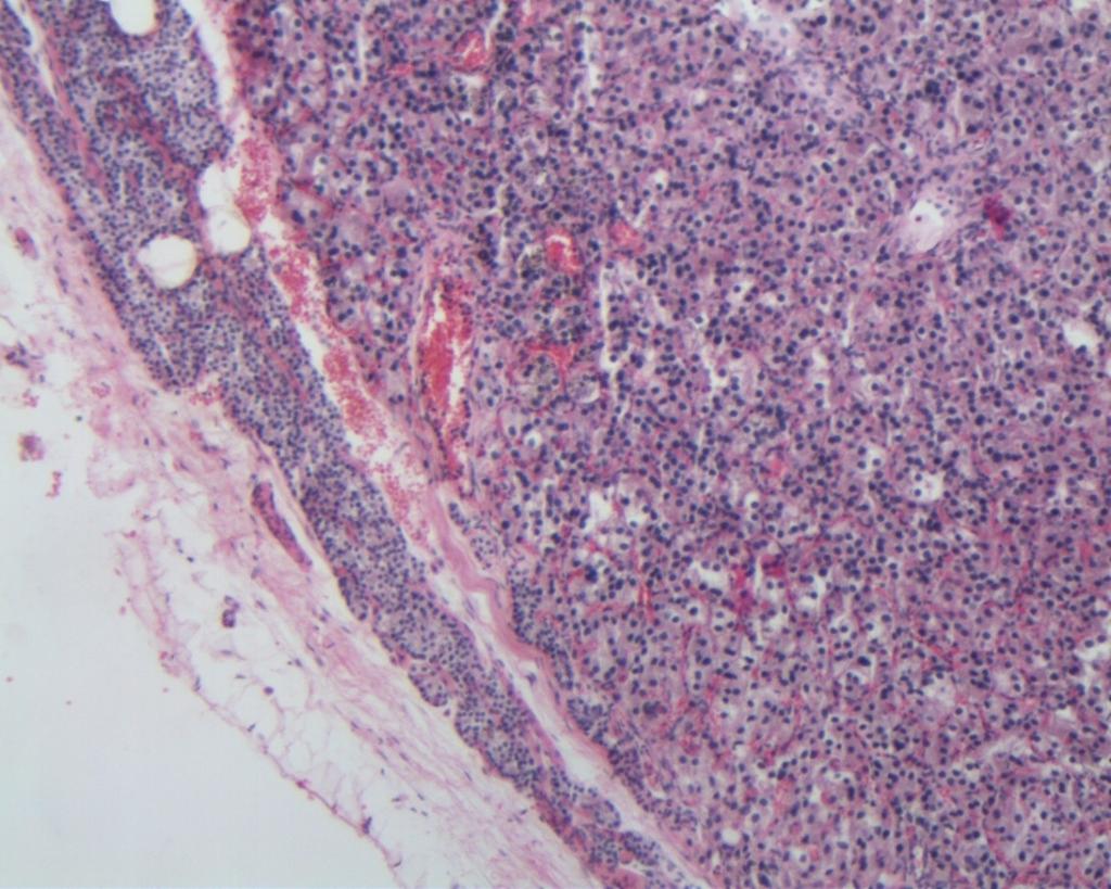 Obr. 7: histologický obraz hyperfunkčního adenomu příštítného tělíska manifestujícího se projevy primární hyperparatyreózy Barvení hematoxilin eozin Normální tkáň příštítného