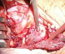 Peroperční obraz pacientky s primární hyperparatyreózou při adenomu příštítného tělíska vpravo* (3 x 1 x 0,8 cm), které je zaškrceno jednou z větví zevně porbíhajícího rekurentu a uloženo částečně